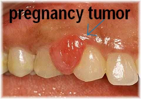 pregnancygingivitis2